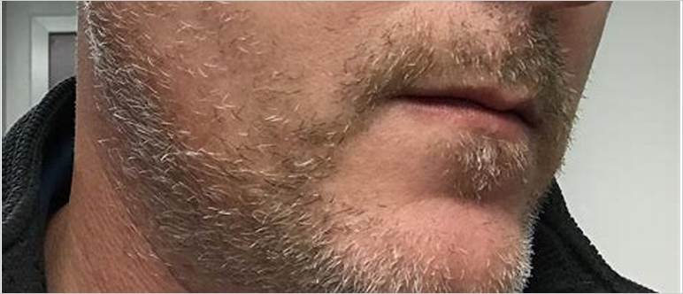 1 week beard growth